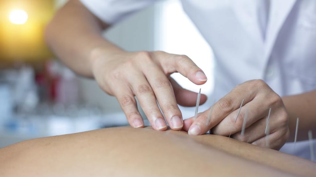 Traitement d'acupuncture à Waterloo, Québec.