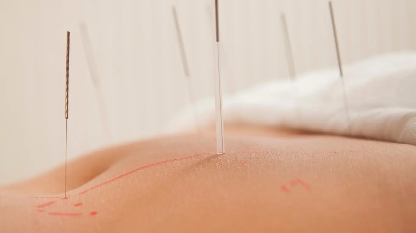 Acupuncture et femme enceinte