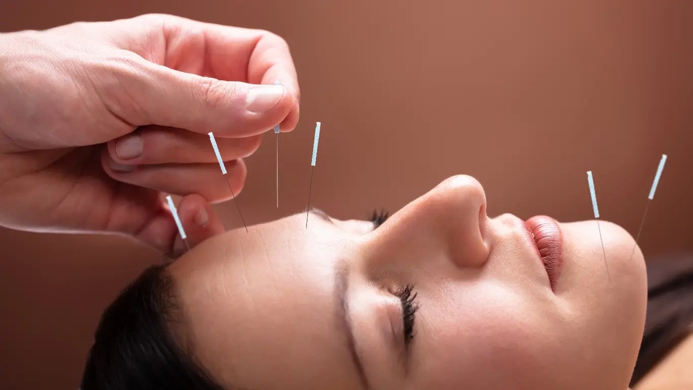 Les bienfaits de l'acupuncture.