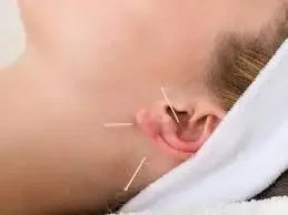 Auriculothérapie pour arrêter de fumer